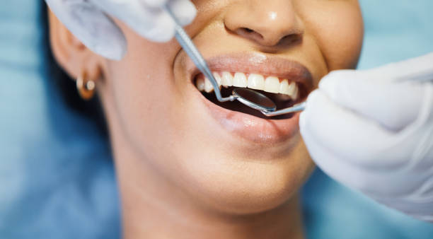 Best Knocked-Out Tooth (Avulsed Tooth) Treatment in Happy Valley, CA