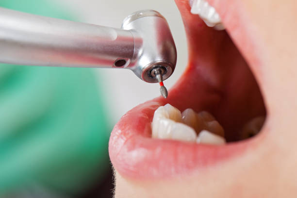 Best Emergency Treatment for Oral Infections in Happy Valley, CA